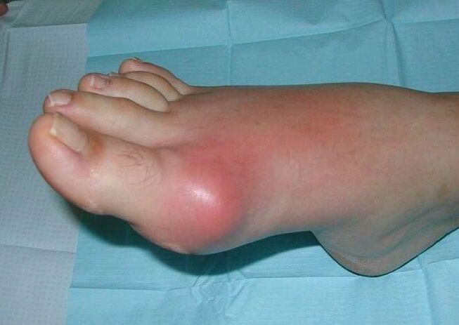 Hình ảnh lâm sàng viêm khớp bàn chân – sưng tấy