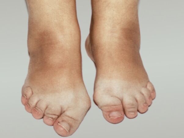 Viêm xương khớp bàn chân với biến dạng nghiêm trọng của ngón chân
