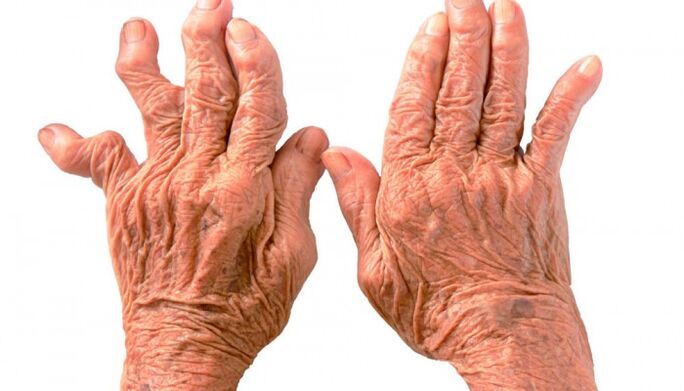 viêm khớp dạng thấp là nguyên nhân gây đau ở khớp ngón tay