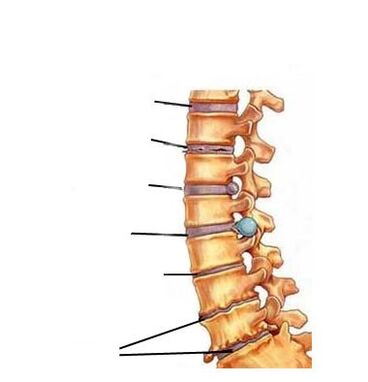 các giai đoạn phát triển của thoái hóa xương khớp