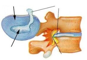 sự phá hủy vòng sợi trong thoái hóa đốt sống cổ