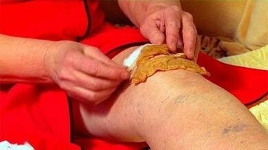 Nén cho bệnh khớp đầu gối