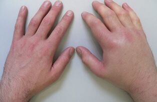 đau khớp là nguyên nhân gây ra đau ở các khớp ngón tay