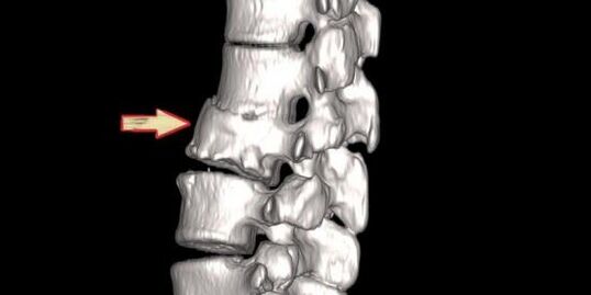 bệnh lý cột sống như một nguyên nhân của đau lưng