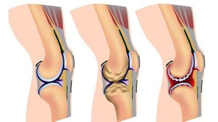Ba mức độ nghiêm trọng của bệnh
