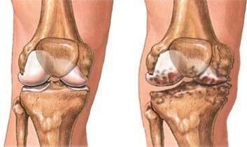 Sự đau khớp đầu gối