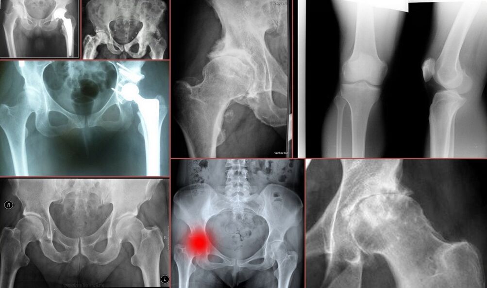 Chụp X-quang cho chứng đau hông