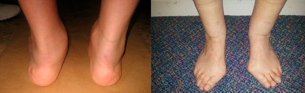 Viêm khớp ngón chân cái và biến dạng khớp cổ chân