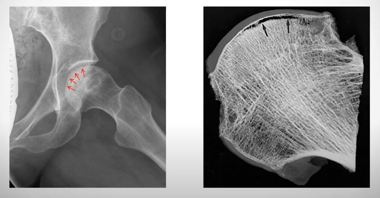 Chụp X-quang chỏm xương đùi bị hoại tử vô trùng