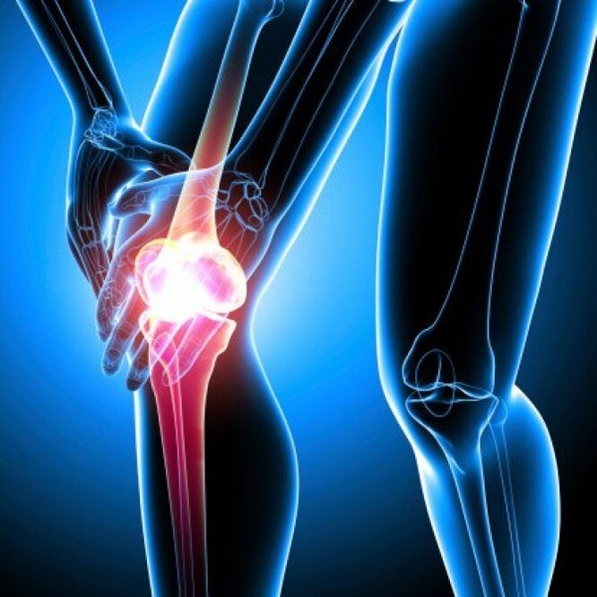 Viêm khớp dạng thấp giai đoạn nặng có thể gây đau hông